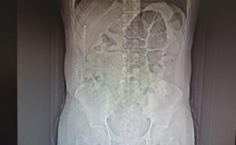İranlı uyuşturucu kuryesinin midesinden 711 gram uyuşturucu çıktı
