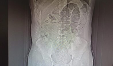 İranlı uyuşturucu kuryesinin midesinden 711 gram uyuşturucu çıktı