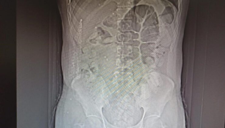İranlı uyuşturucu kuryesinin midesinden 711 gram uyuşturucu çıktı