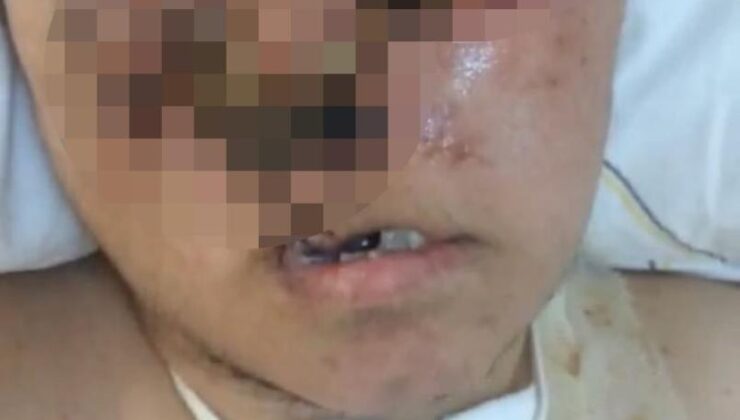 Eniştesinin saldırısı sonucu ağır yaralandı, yüzü tanınmayacak hale geldi