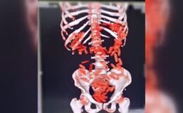 Bir zanlının mide ve bağırsağında uyuşturucu madde bulundu