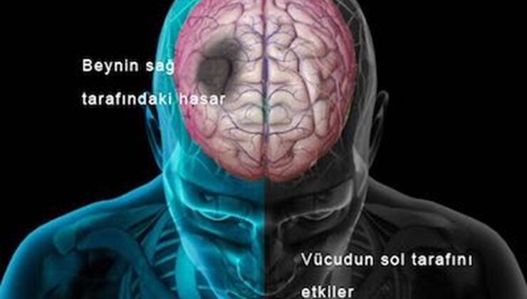 Dünya İnme Günü’nde  kritik uyarılar: Her 4 kişiden biri risk altında!